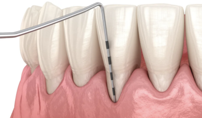 Crown Lengthening and Alveolar Ridge Preservation